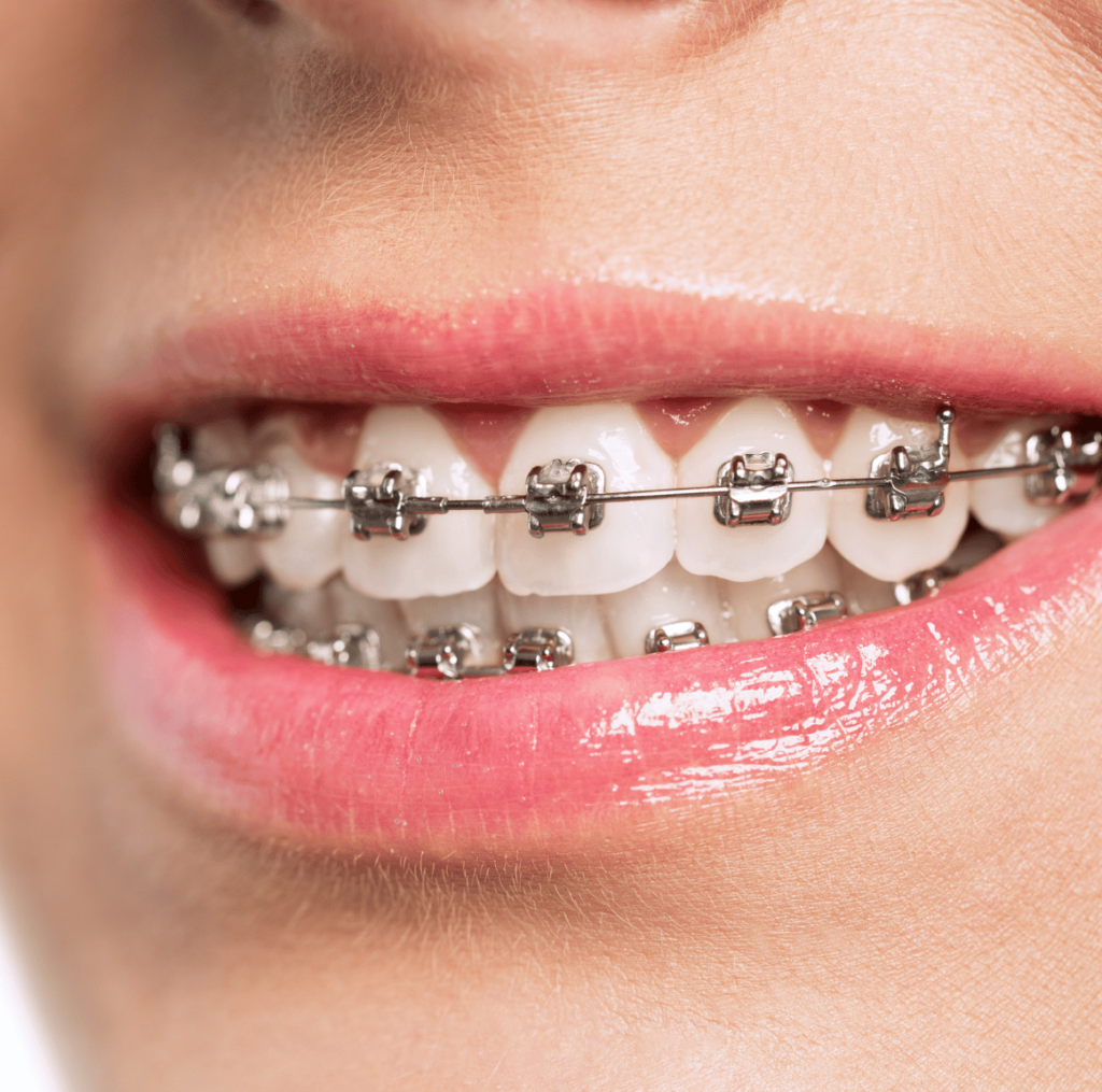 Traditional Braces on Woman Patient - Dr Amanda Koh