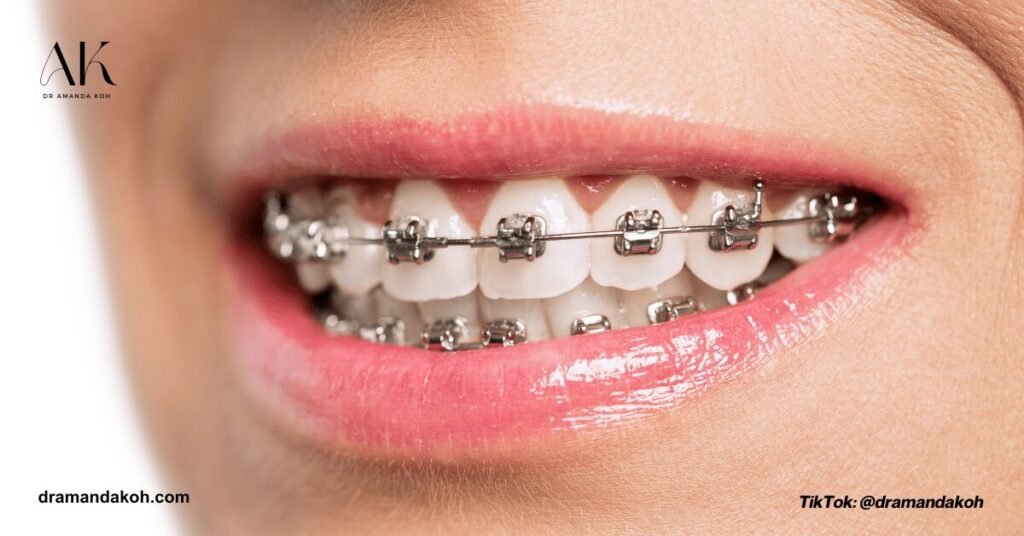 Braces - Dr Amanda Koh